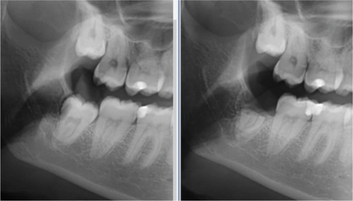 A retrospective study analysing outcomes of the coronectomy procedure at a university dental teaching clinic in Norway.