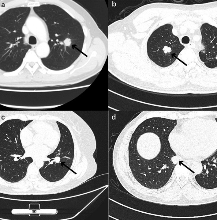 Image-Based Deep Learning Model for Predicting Lymph Node Metastasis in Lung Adenocarcinoma With CT ≤ 2 cm.
