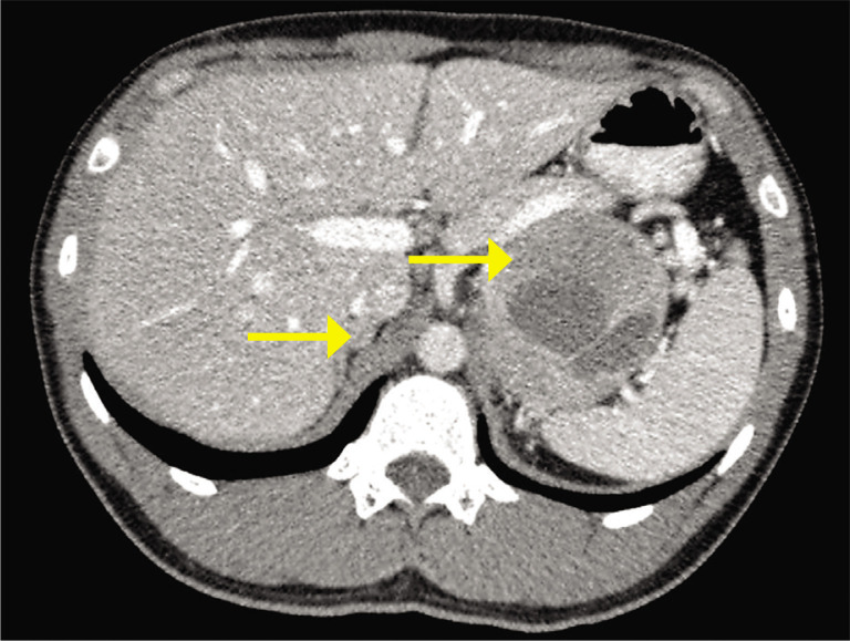 Bilateral Pheochromocytoma with a Novel Pathogenic Variant in the MAX gene: A Case Report.
