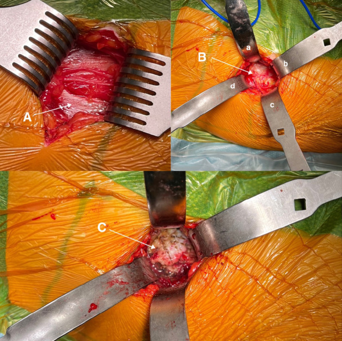 Surgical procedure and retrospective comparative series of Microport's AnteriorPath<sup>®</sup> vs. AMIS<sup>®</sup> in total hip arthroplasty. Preliminary findings from a single institution.
