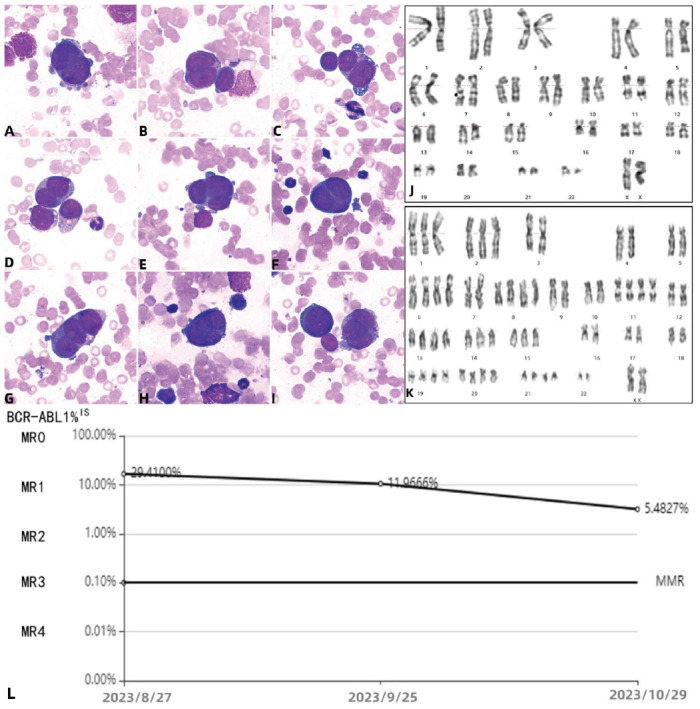 Large and Multi-Nuclei Blasts in Acute Myeloid Leukemia with the Hypotriploid Karyotype and <i>TP53</i> Mutation with P210 <i>BCR::ABL1</i> Transcript