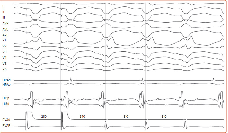 Fascicular and Papillary Muscle Arrhythmias in the Structurally Normal Heart.