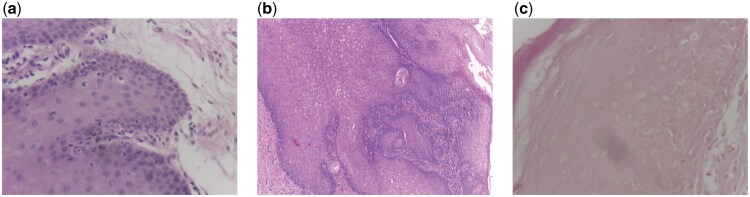 Integrating support vector machines and deep learning features for oral cancer histopathology analysis.