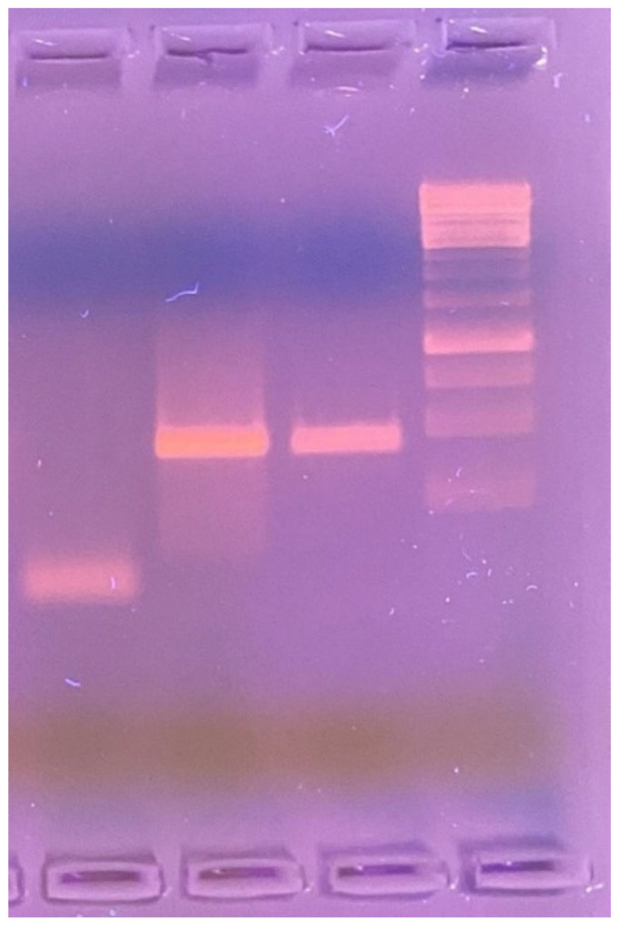 Vasculonecrotic Reaction Caused by Mycobacterium Lepromatosis Infection-A Case Report of an HIV/Leprosy-Coinfected Patient.