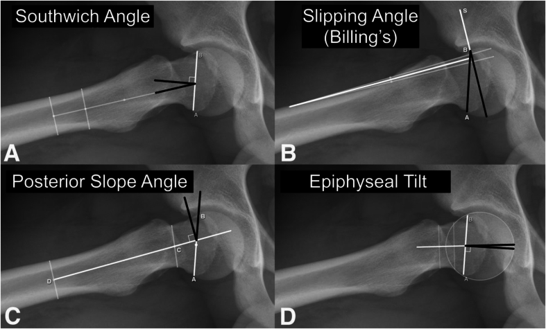 Which Radiographic Measurements Best Predict Contralateral Slip in Patients Who Undergo Pinning for Unilateral Slipped Capital Femoral Epiphysis?