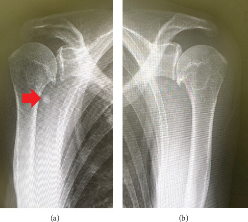 A Novel Case of Tenosynovial Giant Cell Tumor at 4 Years After Total Knee Arthroplasty for Medial Osteoarthritis With Synovial Osteochondromatosis.