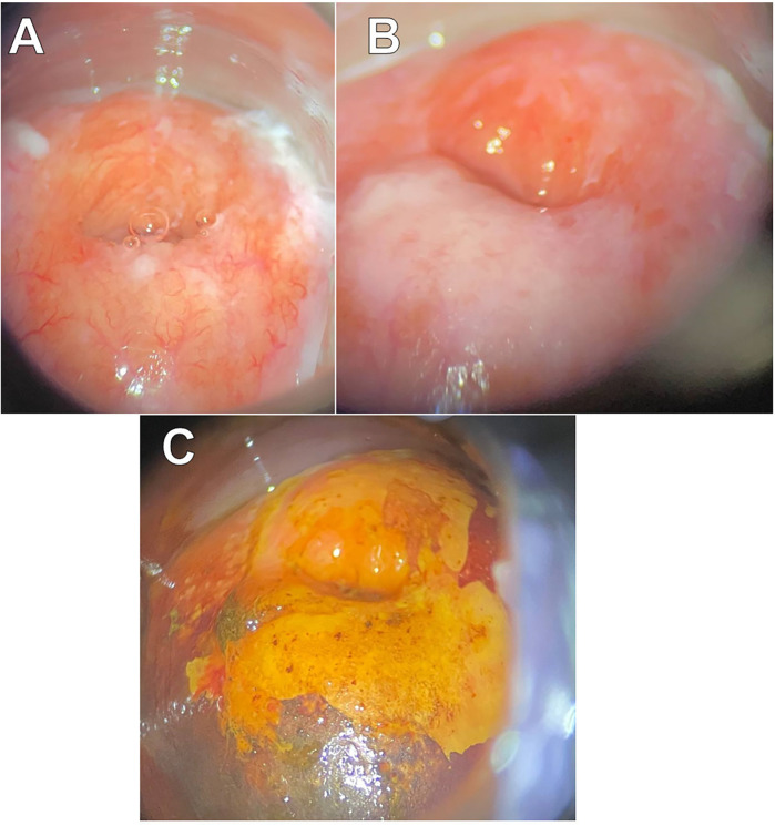 The development of cervical intraepithelial neoplasia in three members of the same family: a case report.