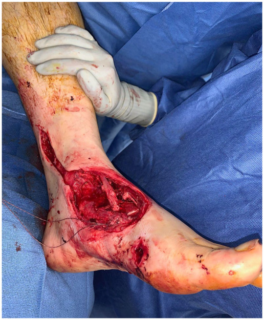 Traumatic Tibialis Anterior Rupture Reconstruction Using Iliotibial Band Autograft.