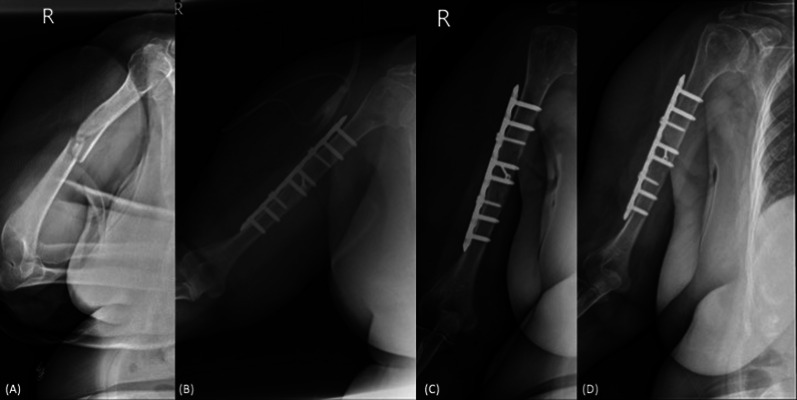 Risk factors associated with delayed union after open reduction and plate fixation for humeral diaphyseal fractures.