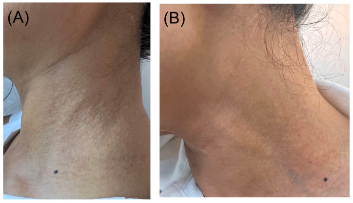 Skin-Colored Papules on the Neck of a Postmenopausal Woman: A Diagnostic Challenge.
