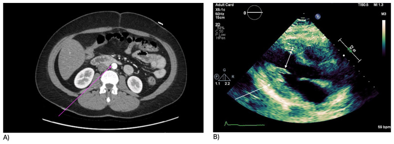 Inferior Wall STEMI in a Young Patient-A Sequela of Phentermine and Smoking.