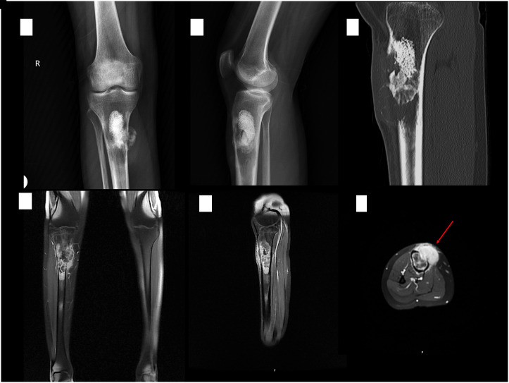 Giant-cell rich osteosarcoma: A report of 3 cases depicting a diagnostic challenge requiring serious attention.