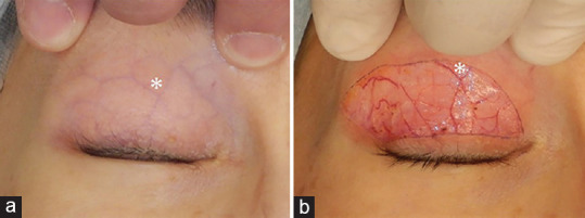 Local anesthesia in upper eyelid surgery - Some considerations.