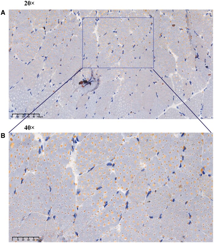 Lipid deposition myopathy due to compound heterozygous mutation in the <i>ETFDH</i> gene: a case report.