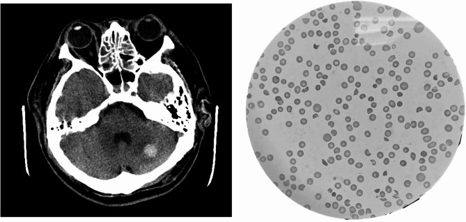 Immune thrombotic thrombocytopenic purpura and diabetic ketoacidosis: a case report and literature review.