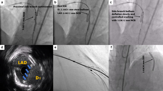 A Novel Modified Mini-Crush Technique for Complex Coronary Bifurcation Lesions: Controlled Balloon-Crush