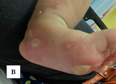 Unforeseen sequela of a traditional remedy: A garlic burn case report.