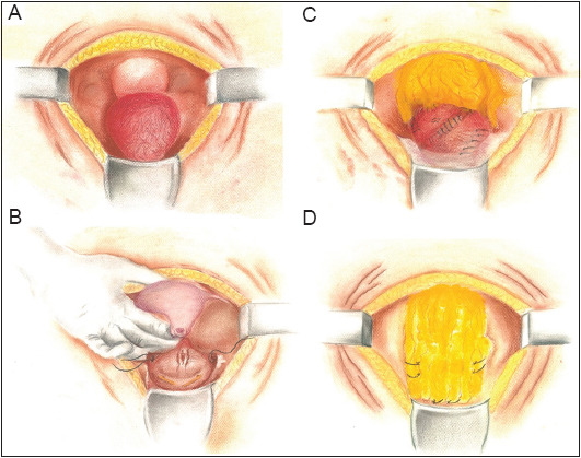 Omental wrap for salvaging bladder repair: A novel approach.