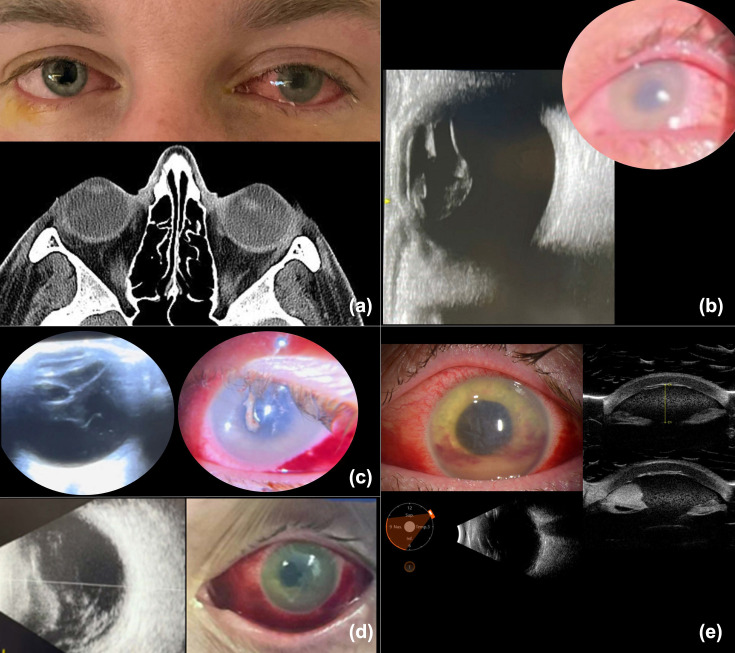 Crystalline lens dislocation as a presenting sign of Streptococcus pyogenes invasive infections.