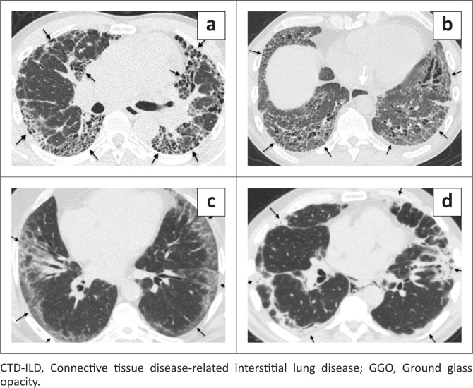 Frequency of imaging phenotypes of pulmonary interstitial fibrosis.
