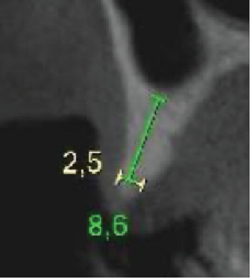 <i>Barbell Technique</i> Associated With <i>Sinus Lift</i> for Horizontal and Vertical Guided Bone Regeneration-Case Report.