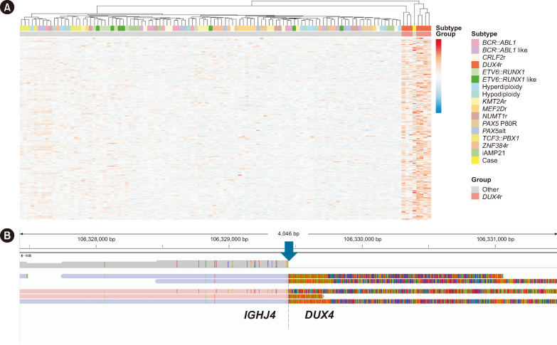 Identification of <i>IGH::DUX4</i> Rearrangements Using RNA-sequencing in a Patient with ALL: A Case Report.