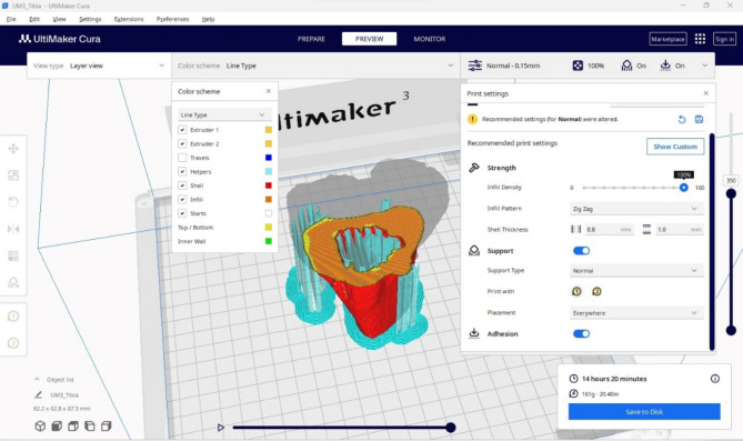 Patient-specific 3D tibial model: transforming meniscal allograft transplantation and surgical planning.