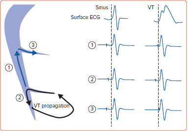 Fascicular and Papillary Muscle Arrhythmias in the Structurally Normal Heart.