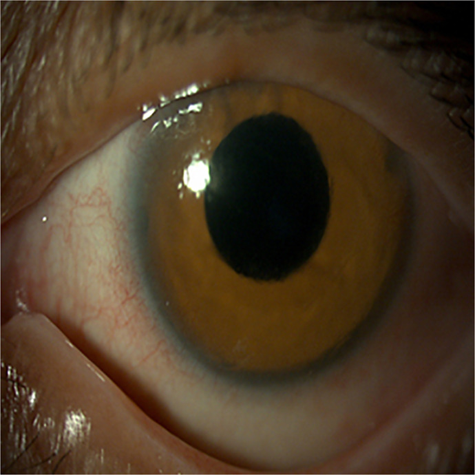 Coexistence of Congenital Aniridia and Ptosis in a Patient with Neurofibromatosis Type I: A Case Report.
