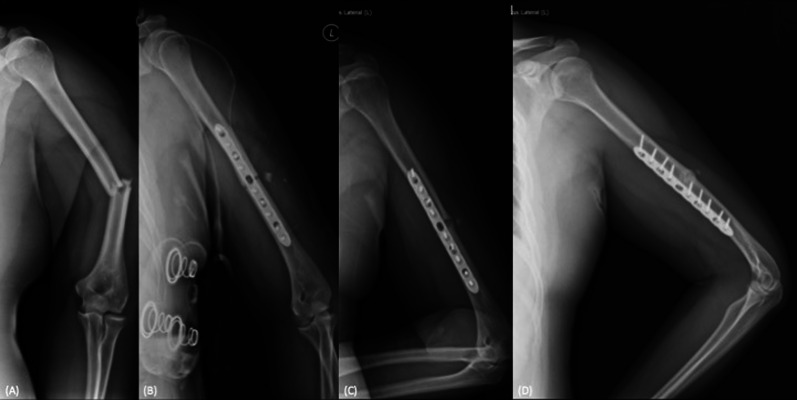 Risk factors associated with delayed union after open reduction and plate fixation for humeral diaphyseal fractures.