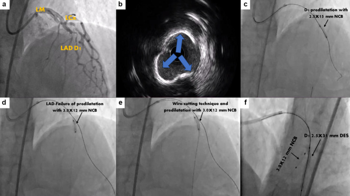 A Novel Modified Mini-Crush Technique for Complex Coronary Bifurcation Lesions: Controlled Balloon-Crush