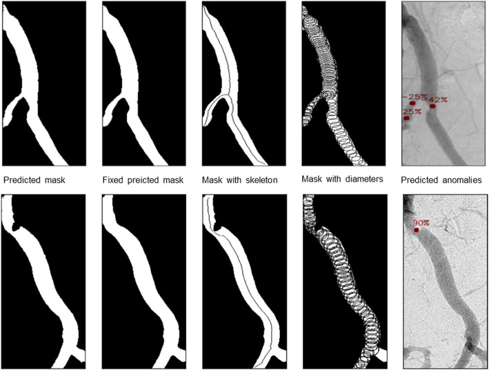 Accuracy of segment anything model for classification of vascular stenosis in digital subtraction angiography.