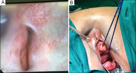 Omental wrap for salvaging bladder repair: A novel approach.