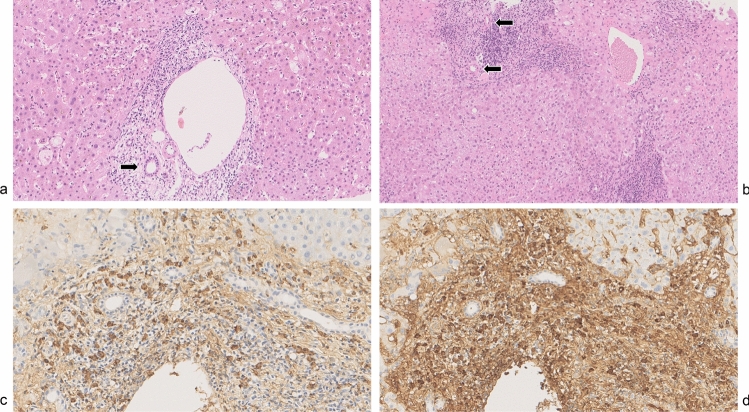 A clinicopathological study of IgG4-related autoimmune hepatitis and IgG4-hepatopathy.