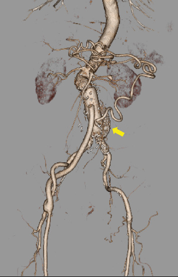A Surgical Case of an Abdominal Aortic Aneurysm With a Meandering Inferior Mesenteric Artery due to Superior Mesenteric Artery Occlusion.
