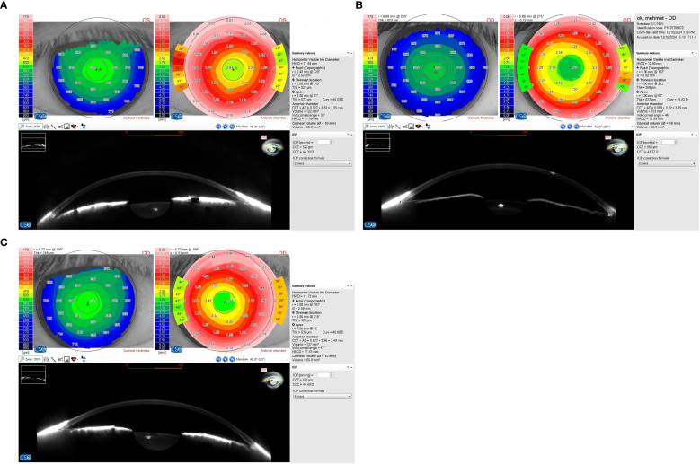 Low anterior chamber volume as a risk factor in non-arteritic anterior ischemic optic neuropathy.