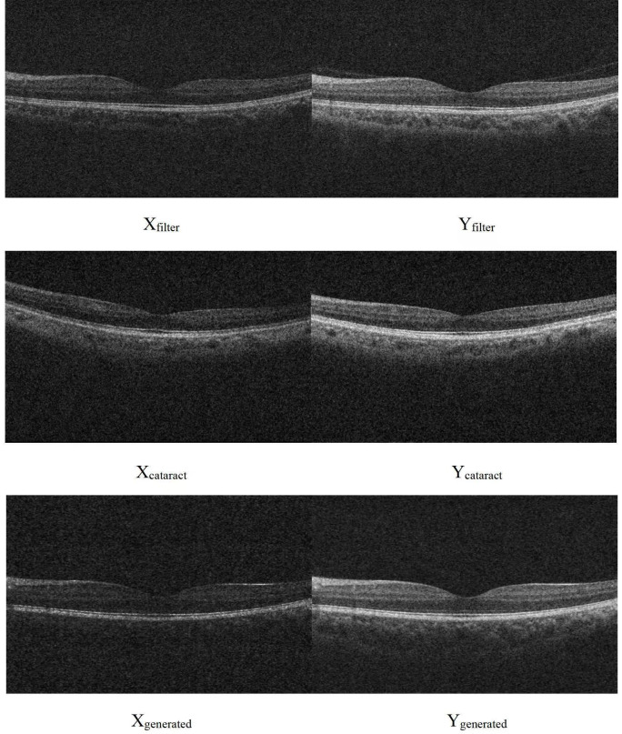 Application of generative adversarial networks in the restoration of blurred optical coherence tomography images caused by optical media opacity in eyes.