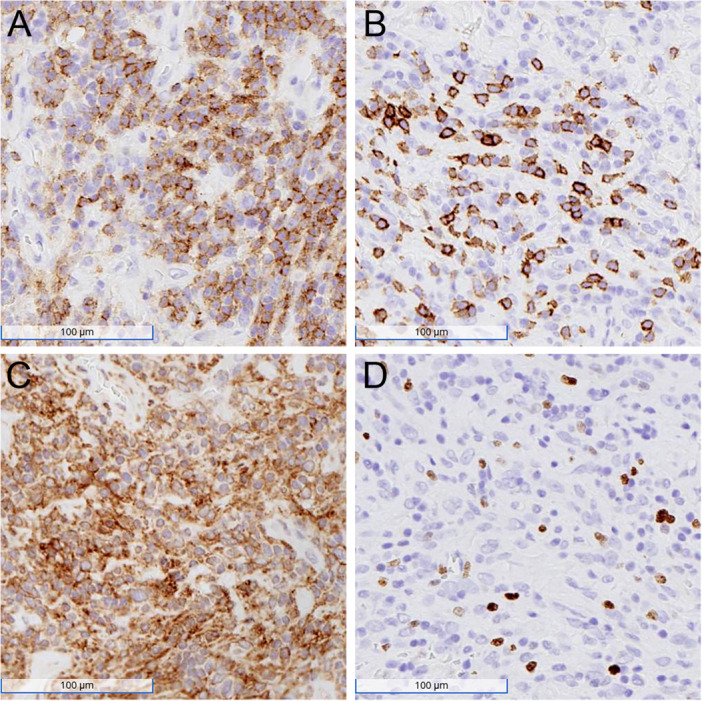 Follicular Dendritic Cell Sarcoma of the Parapharyngeal Space Arising in Association With Castleman Disease.