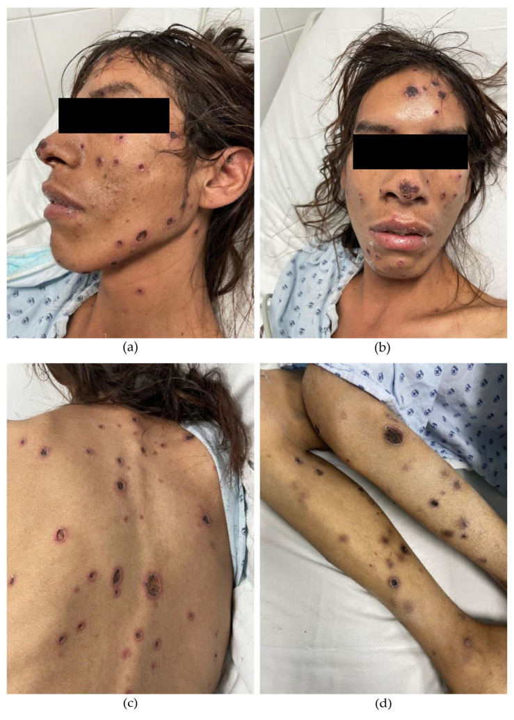 Vasculonecrotic Reaction Caused by Mycobacterium Lepromatosis Infection-A Case Report of an HIV/Leprosy-Coinfected Patient.