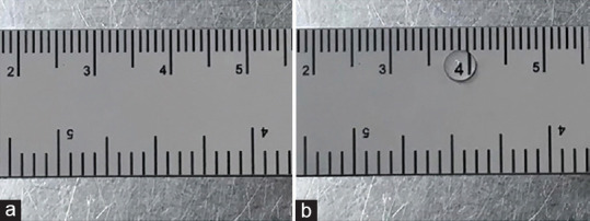 Local anesthesia in upper eyelid surgery - Some considerations.