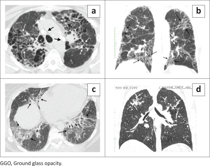 Frequency of imaging phenotypes of pulmonary interstitial fibrosis.
