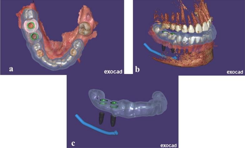 Early versus conventional loading for fully guided immediate implant placement in molar sites: a randomized controlled clinical study.