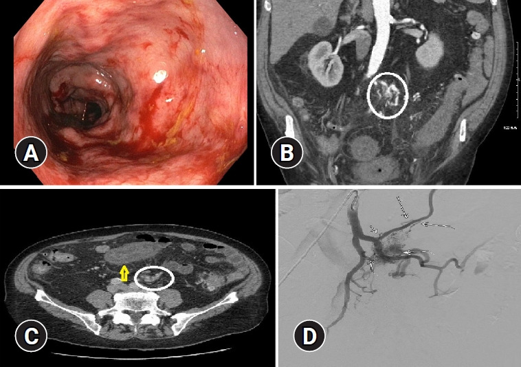 Mesenteric arteriovenous malformation with associated inferior mesenteric vein occlusion: a rare cause of ischemic colitis.