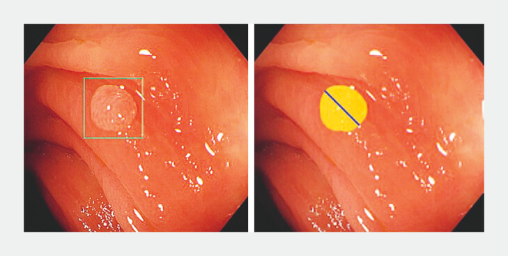 Use of artificial intelligence to measure colorectal polyp size without a reference object.