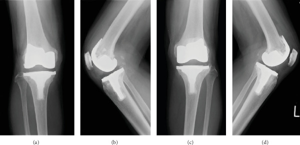 A Novel Case of Tenosynovial Giant Cell Tumor at 4 Years After Total Knee Arthroplasty for Medial Osteoarthritis With Synovial Osteochondromatosis.