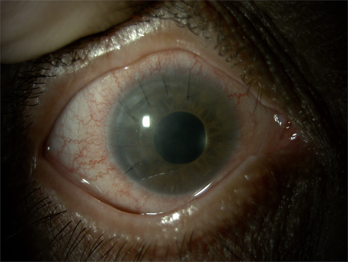 Coexistence of Congenital Aniridia and Ptosis in a Patient with Neurofibromatosis Type I: A Case Report.