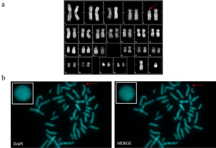 Establishment and characterization of Cri Du Chat neuronal stem cells: a novel promising resource to study the syndrome.