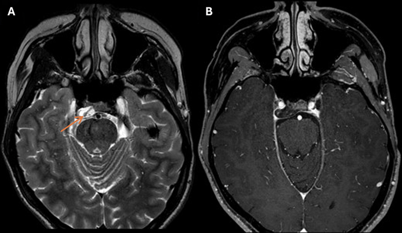 Spontaneous Shrinking and Growing Skull Base Chordoma.