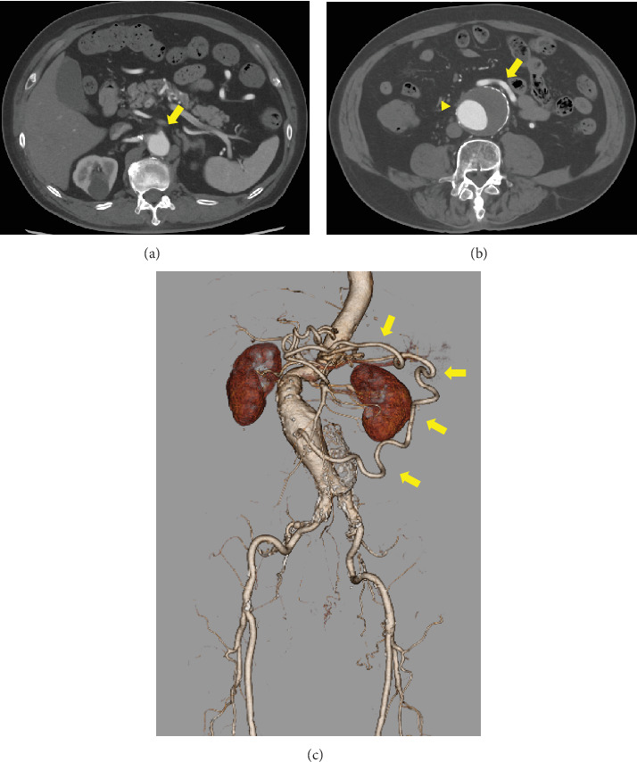 A Surgical Case of an Abdominal Aortic Aneurysm With a Meandering Inferior Mesenteric Artery due to Superior Mesenteric Artery Occlusion.