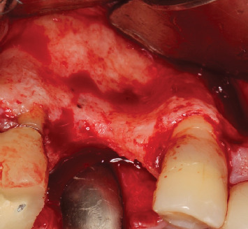 <i>Barbell Technique</i> Associated With <i>Sinus Lift</i> for Horizontal and Vertical Guided Bone Regeneration-Case Report.